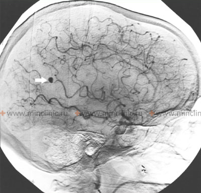 На выполненной ангиографии артерий головного мозга в боковой проекции показана микотическая аневризма в теменно-затылочной области.